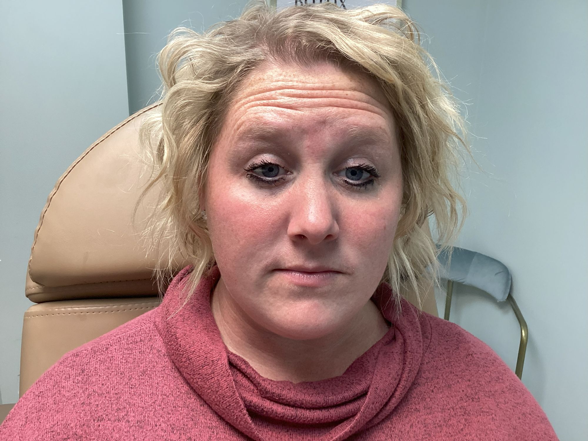 Botox treatment