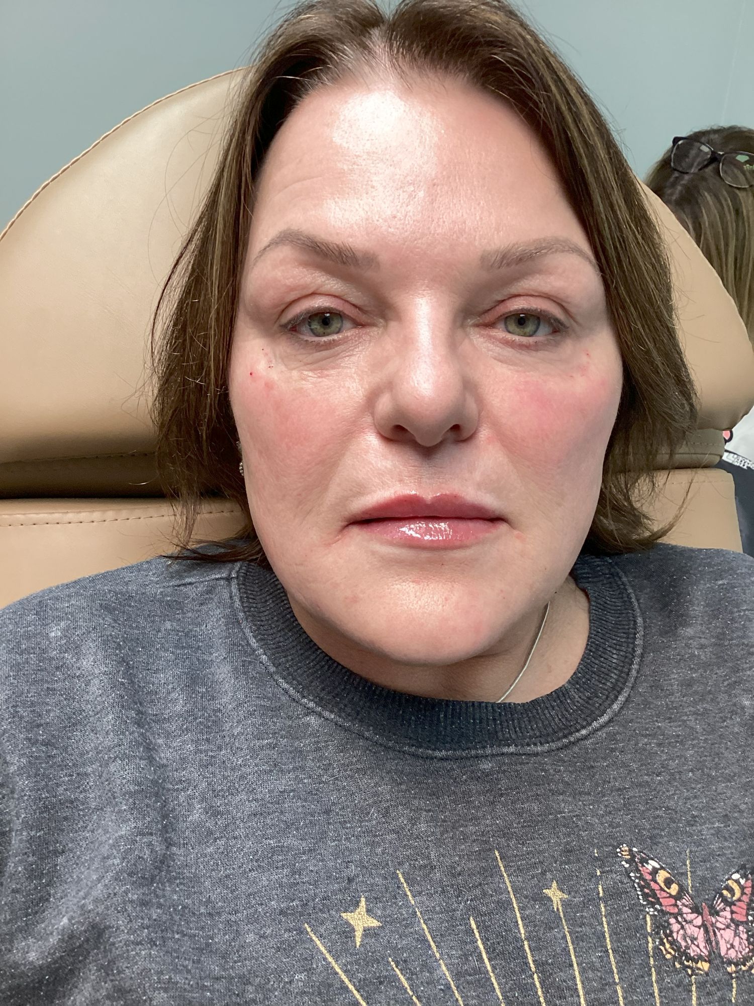 Dermal Lip Filler