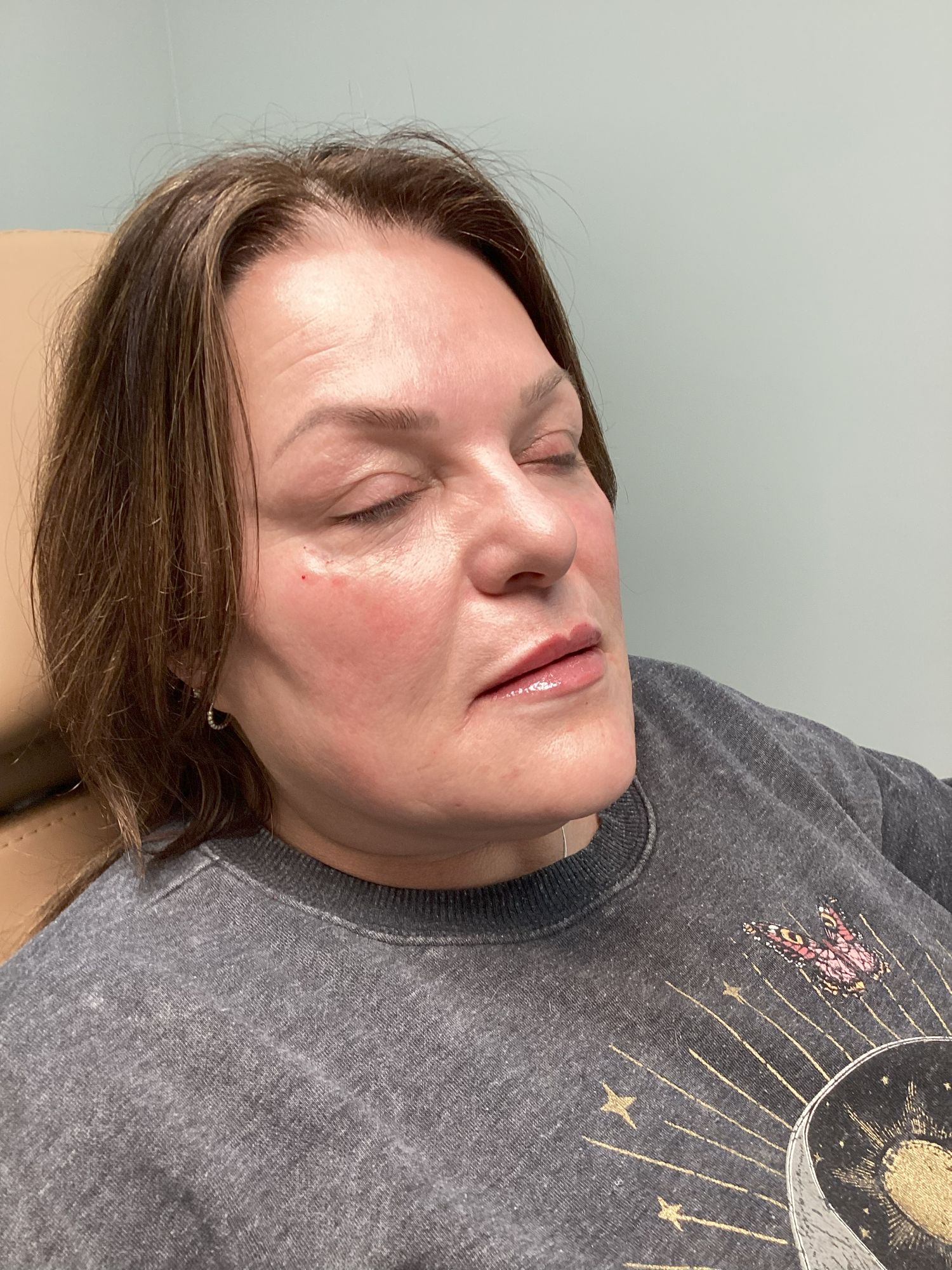 Dermal Lip Filler