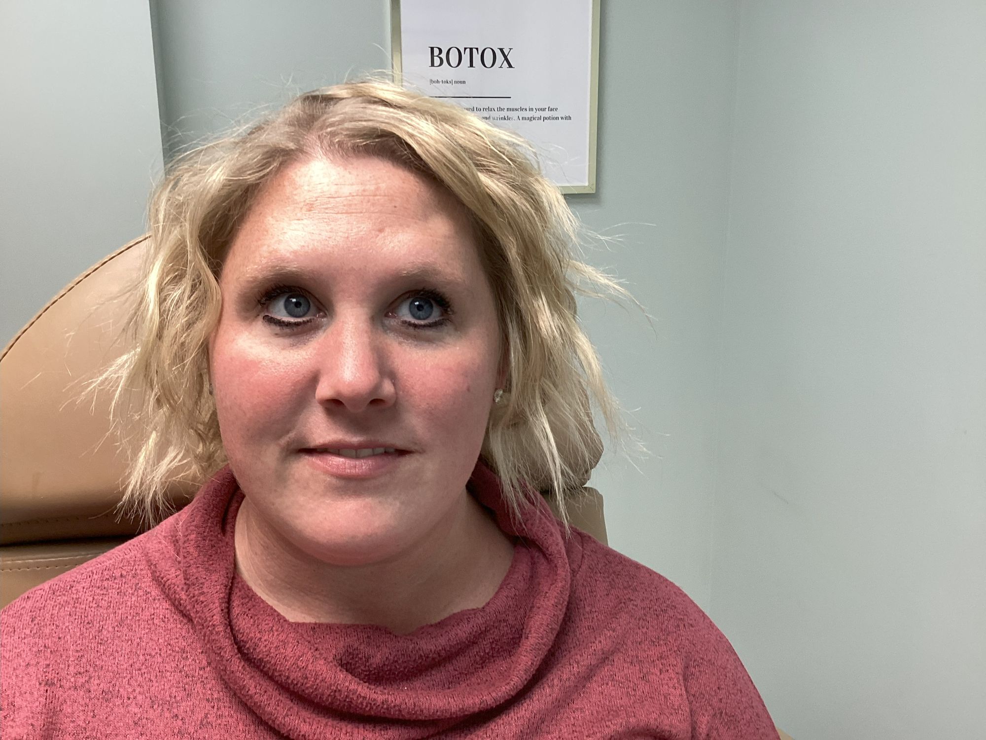botox treatment