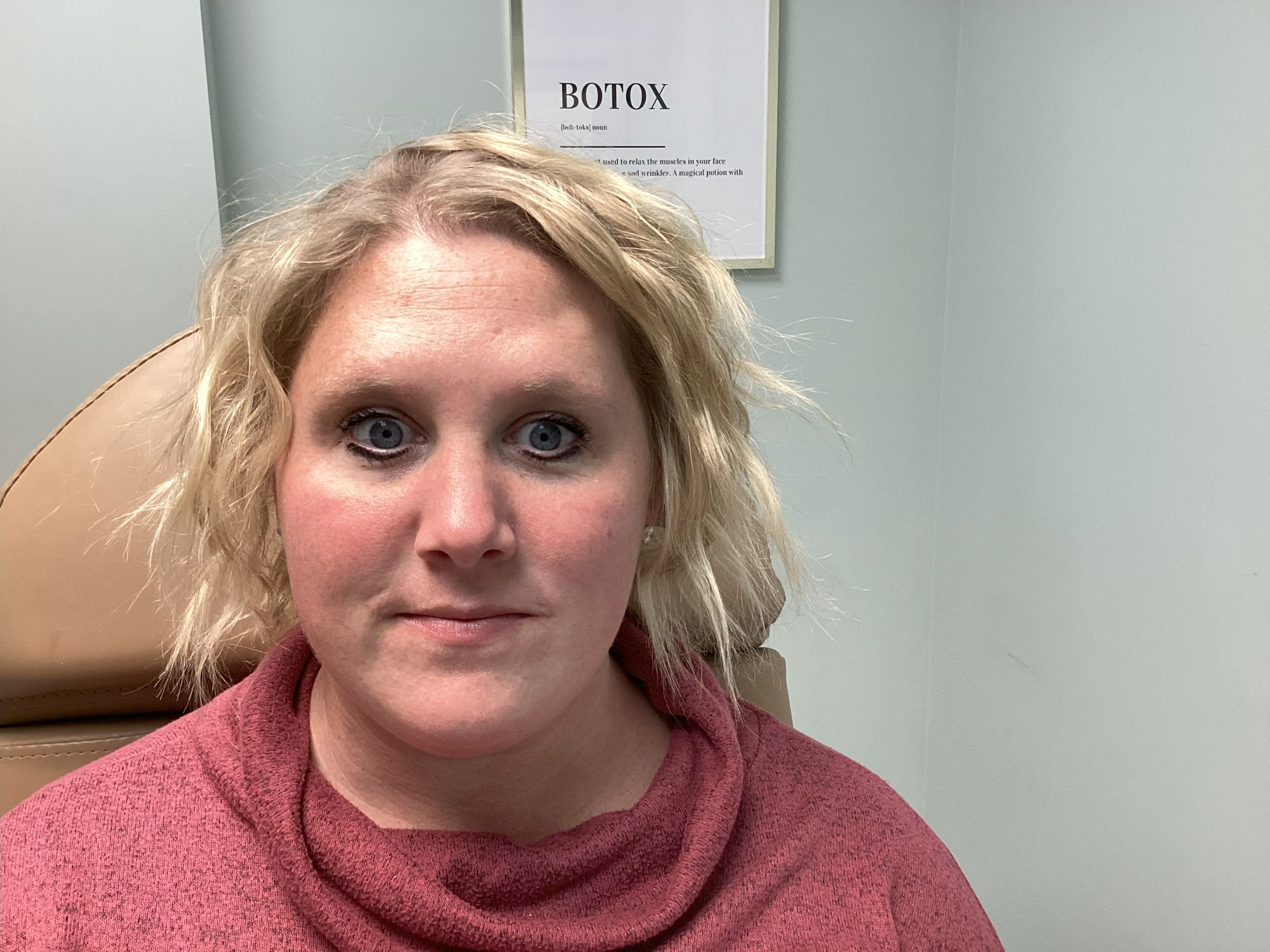 botox treatment