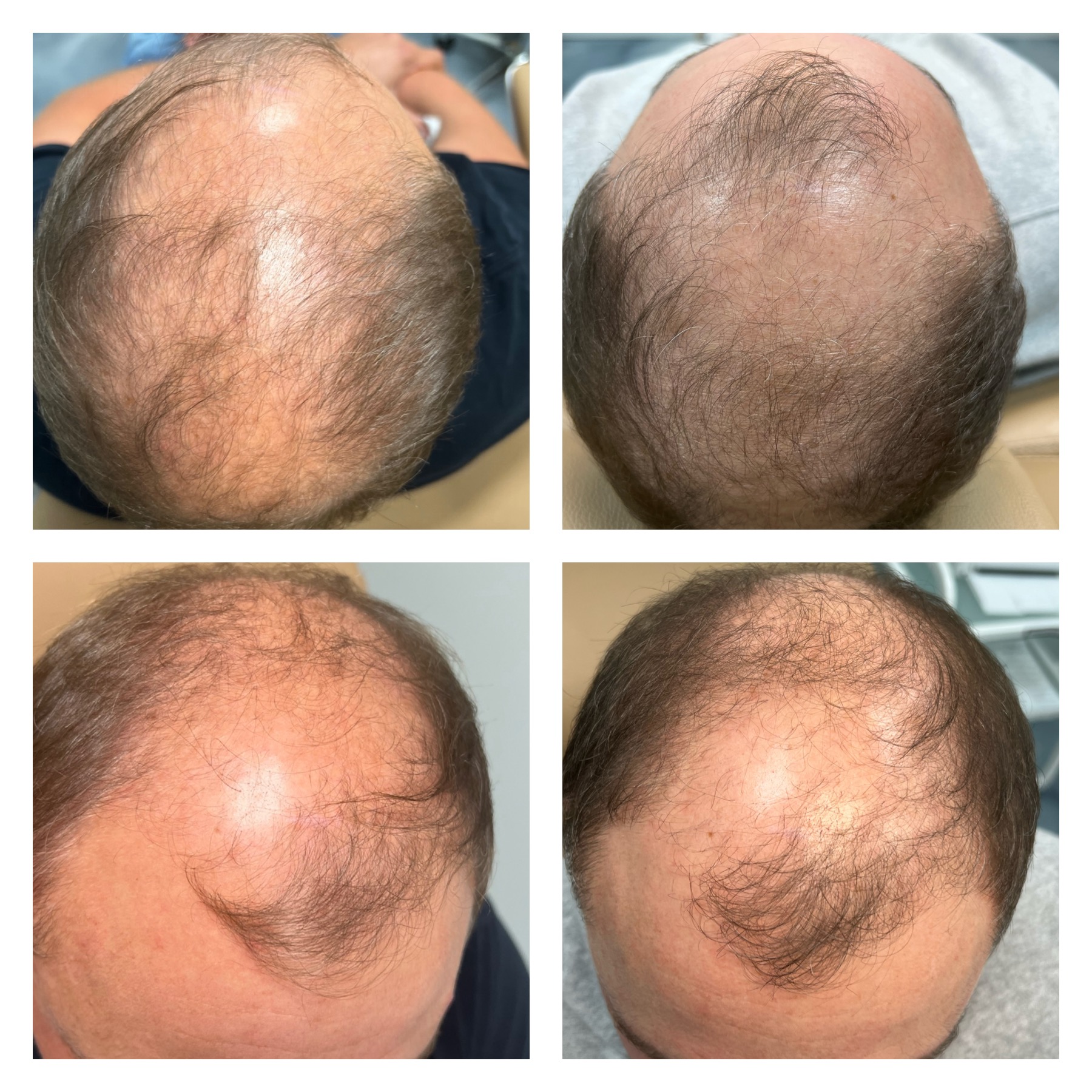 Hair Restoration Mankato, Mn