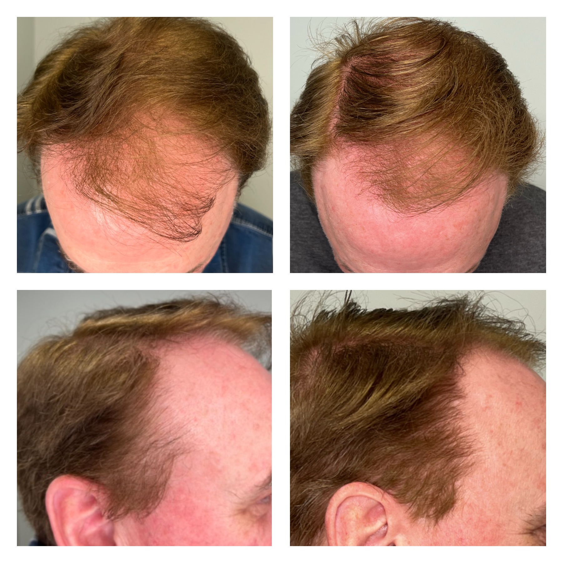Hair Restoration Mankato, MN