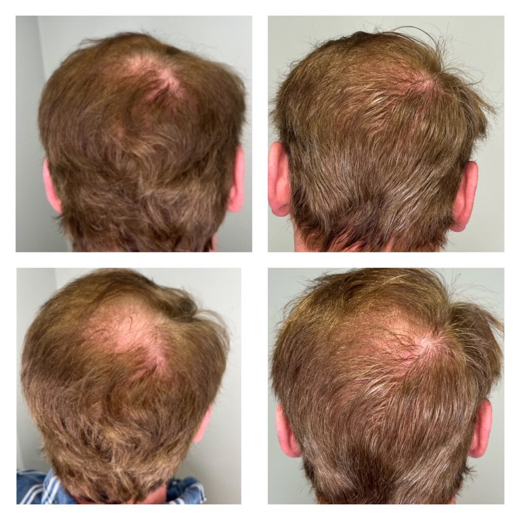 Hair Restoration Mankato