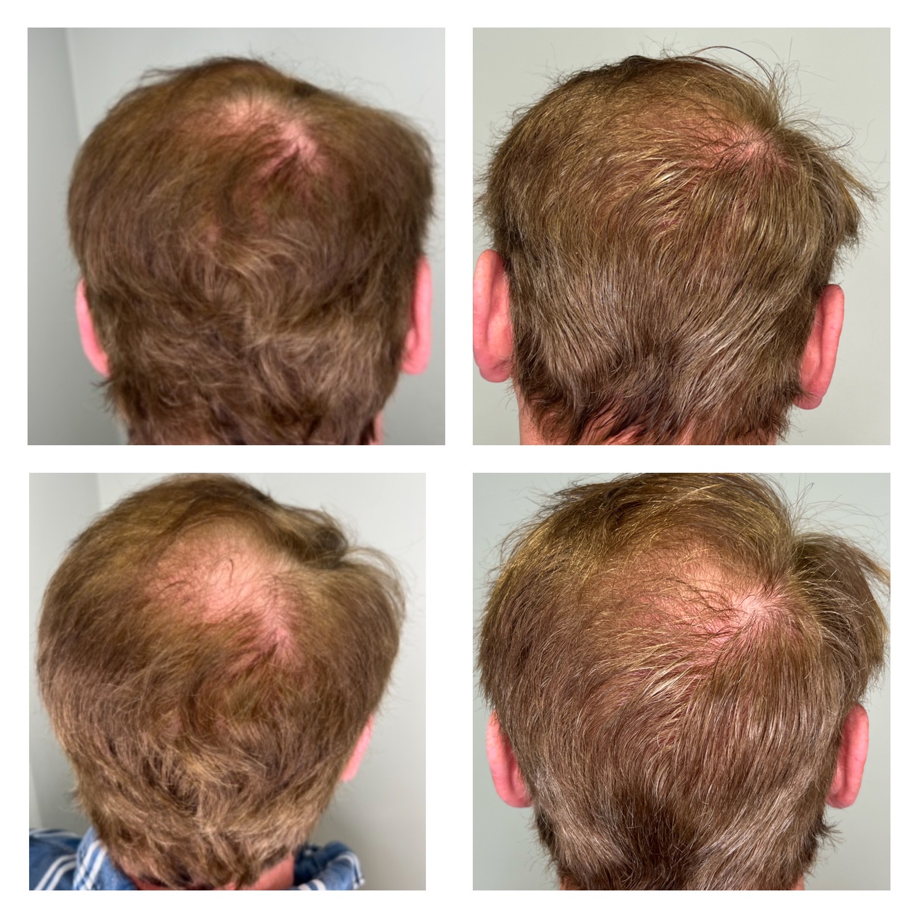 Hair Restoration Mankato