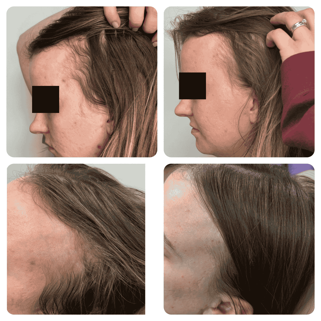 Hair Restoration Mankato, MN