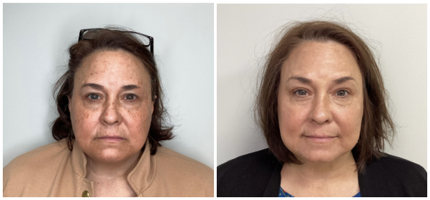 Before & After of a hyperpigmentation treatment in Mankato, MN, using an IPL Photofacial. 